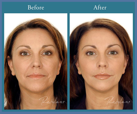 Diver Visible Deviate Cosmetic Fillers - Dermatology Specialists of Naples