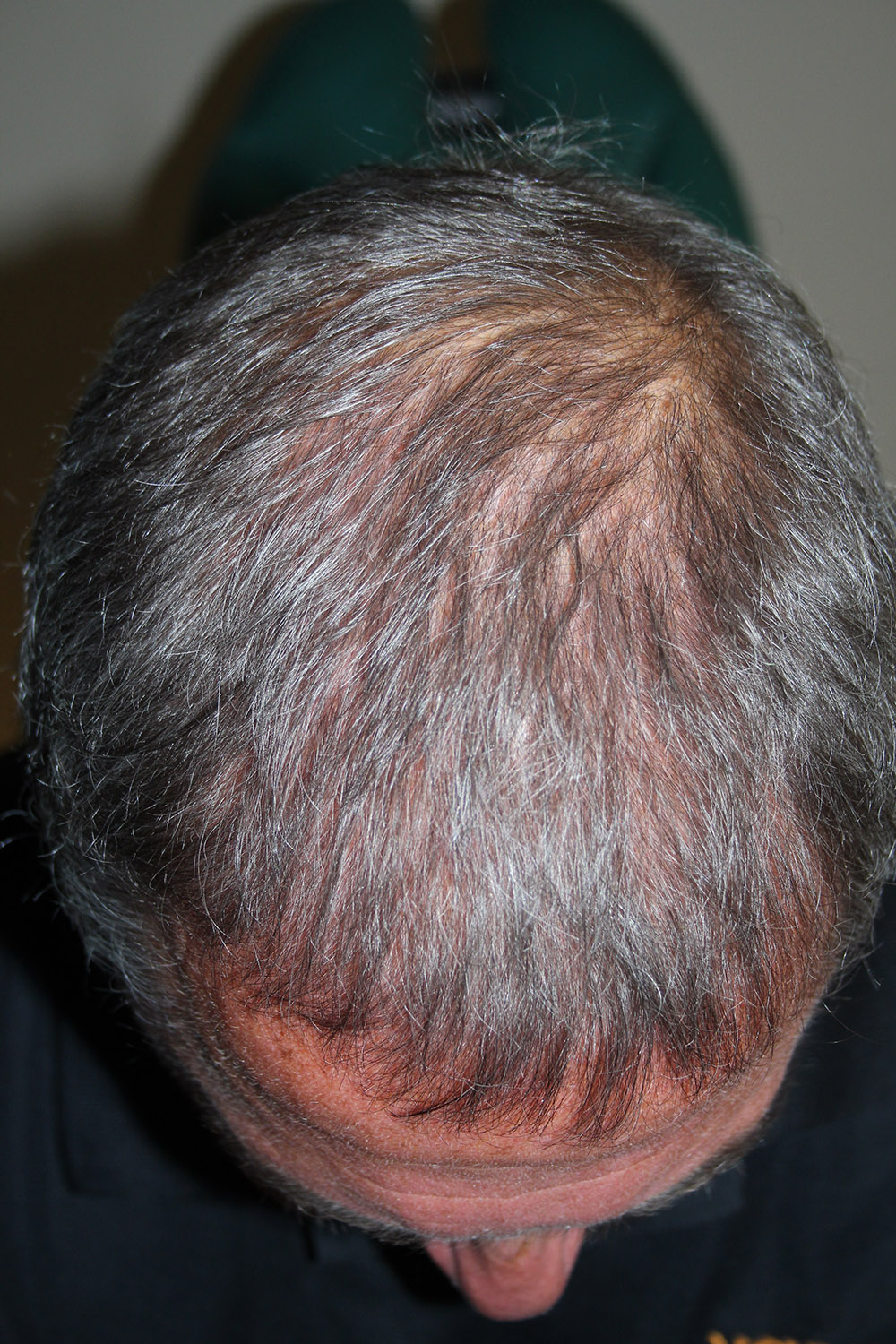 PRP Therapy for Hair Restoration - Dermatology Specialists of Naples