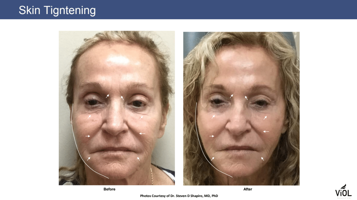 Skin Tightening 2