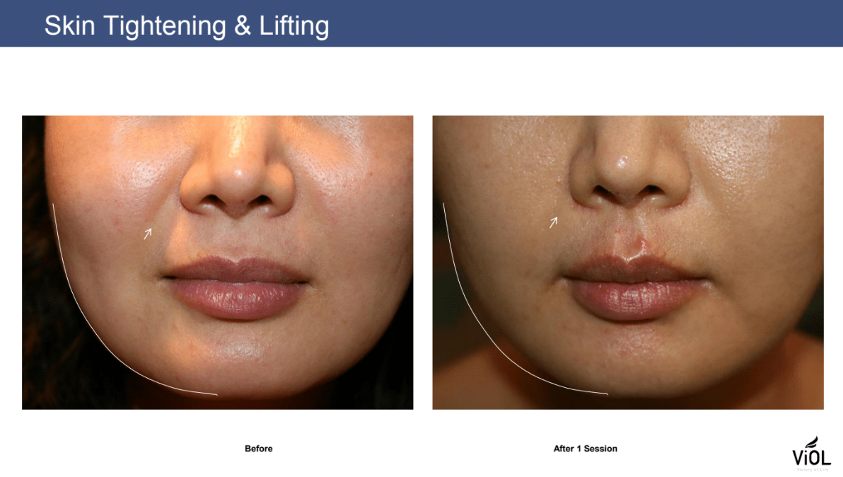 Skin Tightening and Lifting