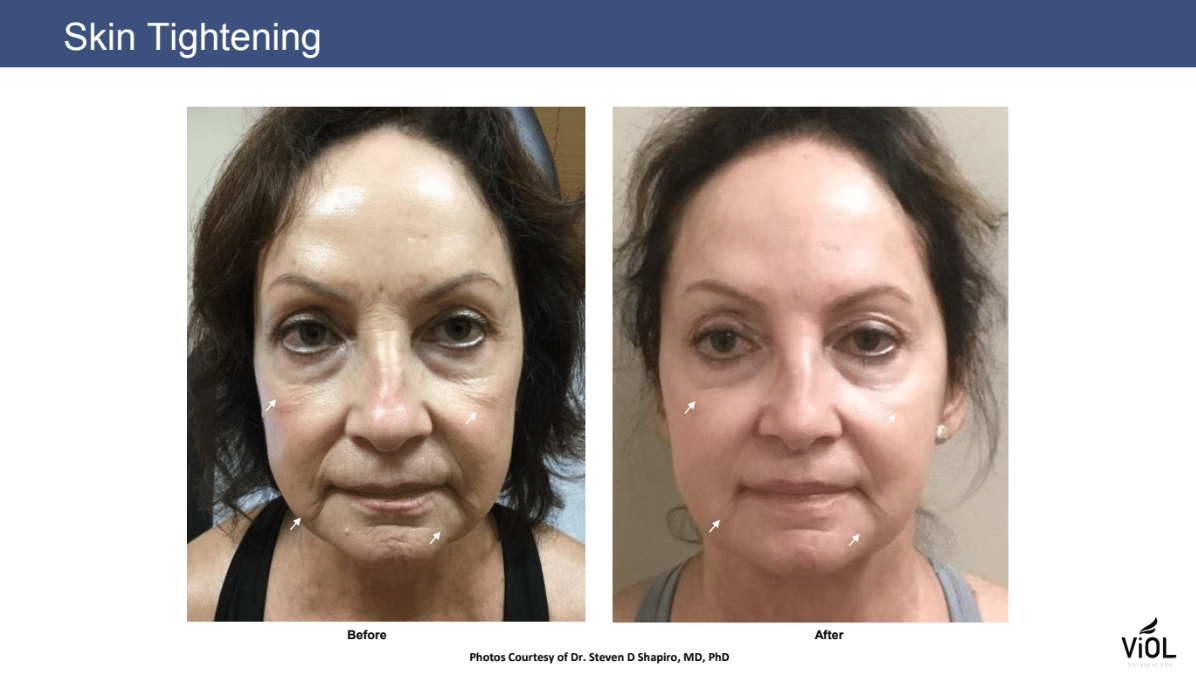 Skin Tightening